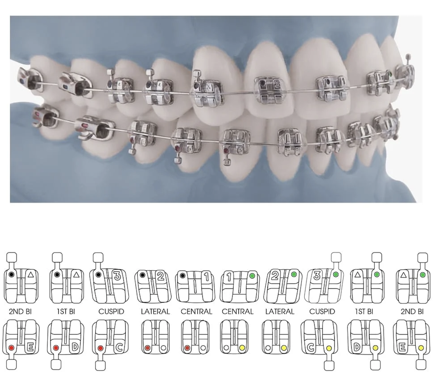 Mắc cài kim loại chỉnh nha RMO – Lựa chọn tối ưu cho nha sĩ hiện đại